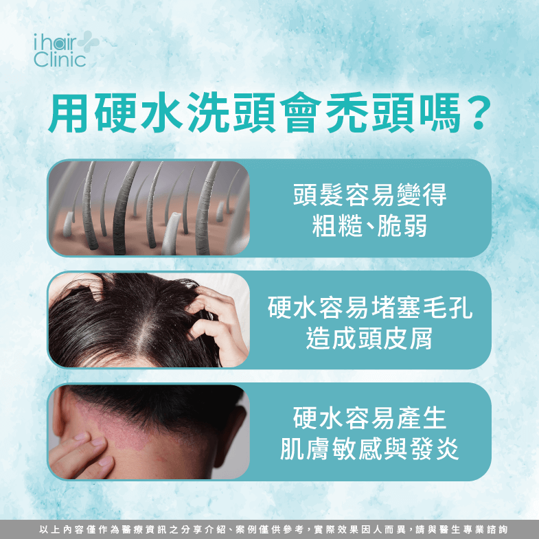 硬水洗頭會禿頭嗎-硬水 禿頭-硬水 掉頭髮