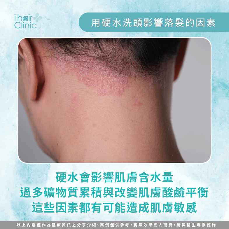 頭皮敏感-硬水 禿頭-硬水 掉頭髮