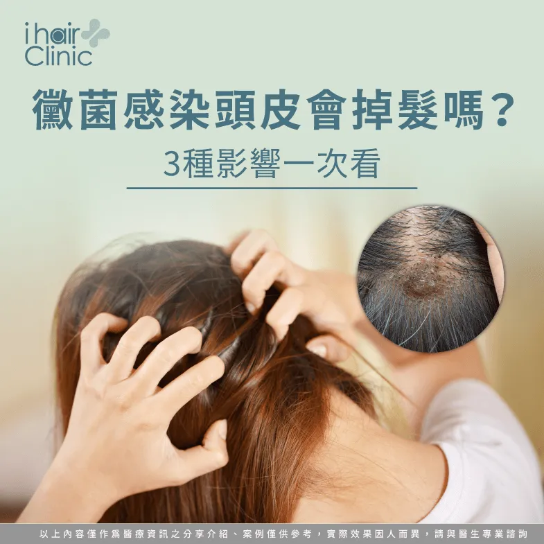 黴菌感染頭皮掉髮的3種原因解析-黴菌 頭皮 掉髮