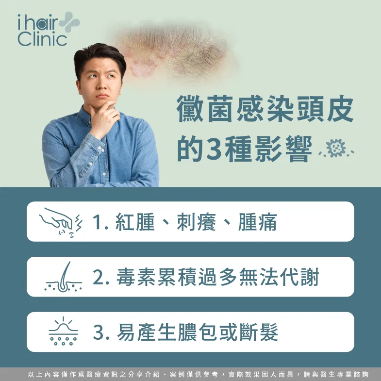 3種黴菌感染頭皮的常見症狀一次看-黴菌掉髮