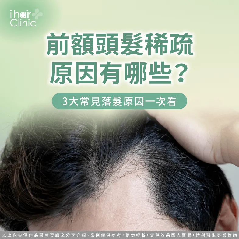 前額頭髮稀疏原因有哪些?3大原因解析一次報你知 前額頭髮稀疏3點原因帶你看-前額頭髮稀疏