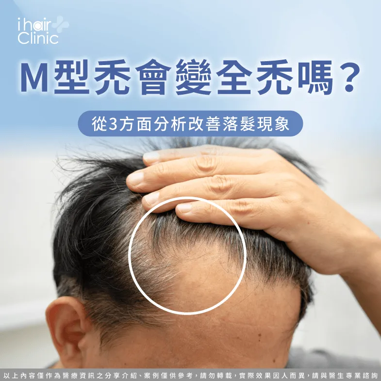 M型禿會 全禿-M型禿會 變嚴重