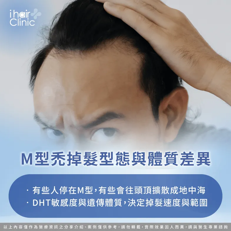 掉髮型態-M型禿會 全禿