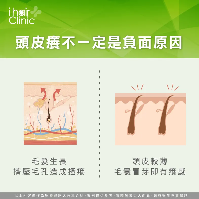頭皮癢毛髮生長-頭皮癢會禿頭嗎