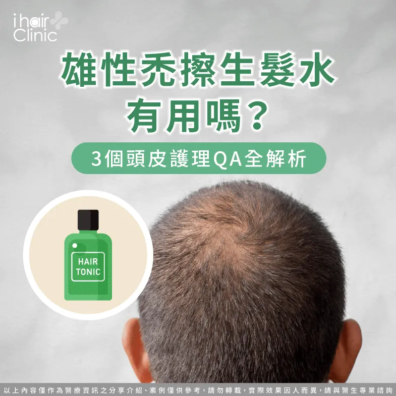 3問答解析雄性禿能否使用生髮水治療-雄性禿 生髮水