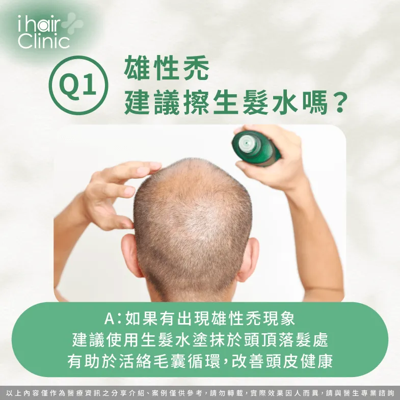 雄性禿可以使用生髮水抑制掉髮-雄性禿 生髮水