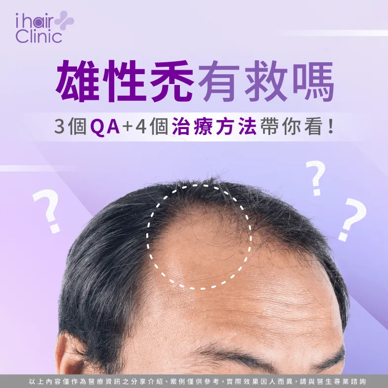 3個雄性禿QA及4種治療方法-雄性禿有救嗎