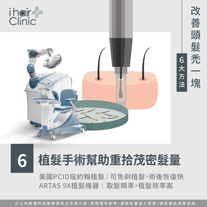 植髮手術-頭頂 禿一塊
