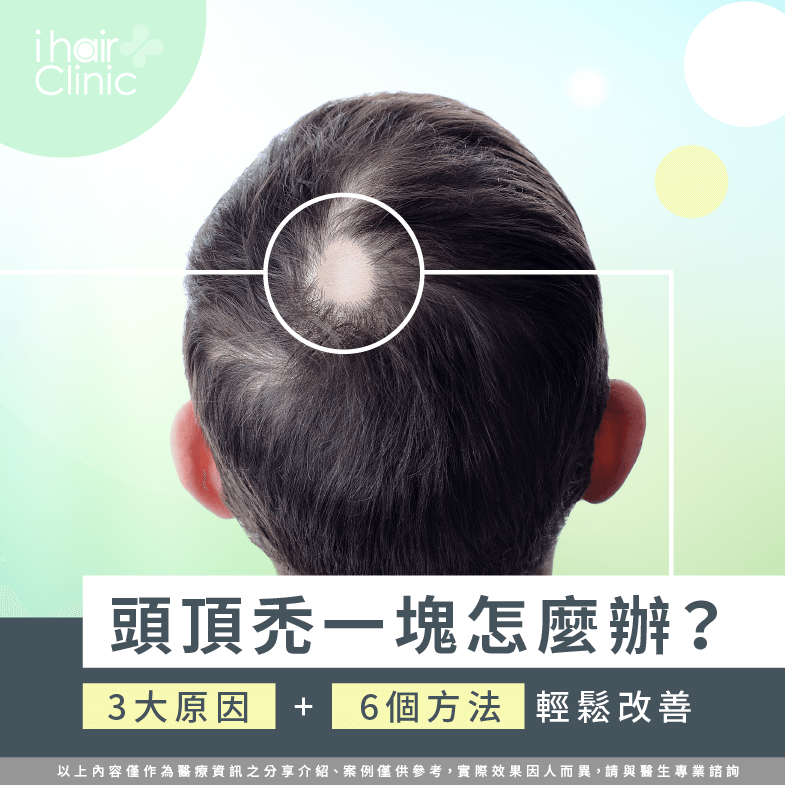 3個原因及6個改善方式-頭頂 禿一塊
