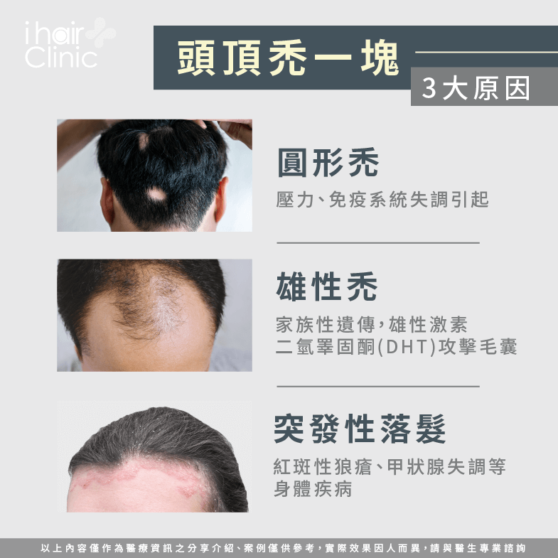 3個禿頭原因-頭頂 禿一塊