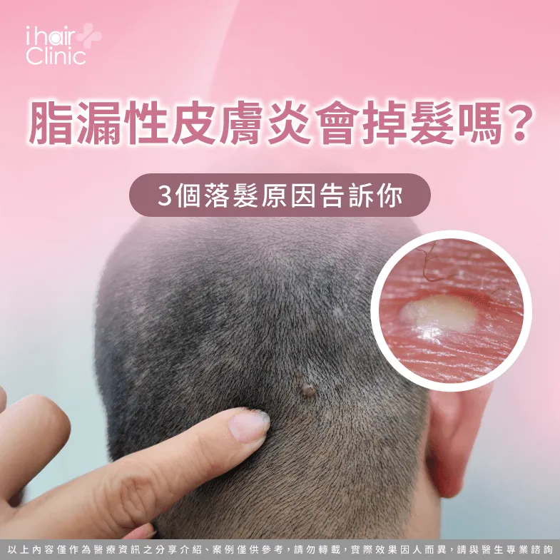 脂漏性皮膚炎掉髮3大原因解析-脂漏性皮膚炎會掉髮嗎