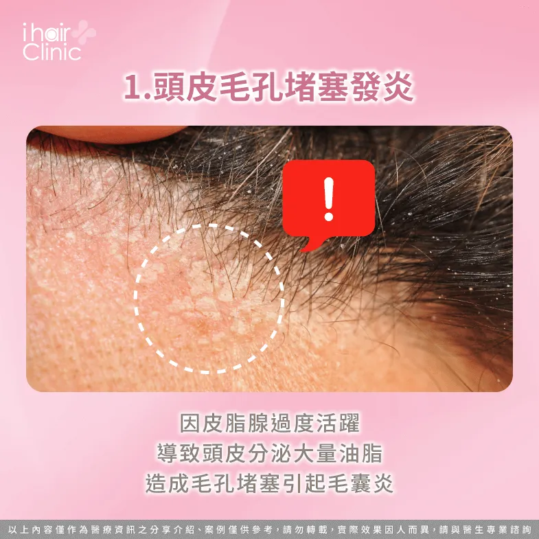 頭皮油脂分泌旺盛導致毛孔堵塞-脂漏性皮膚炎會掉髮嗎
