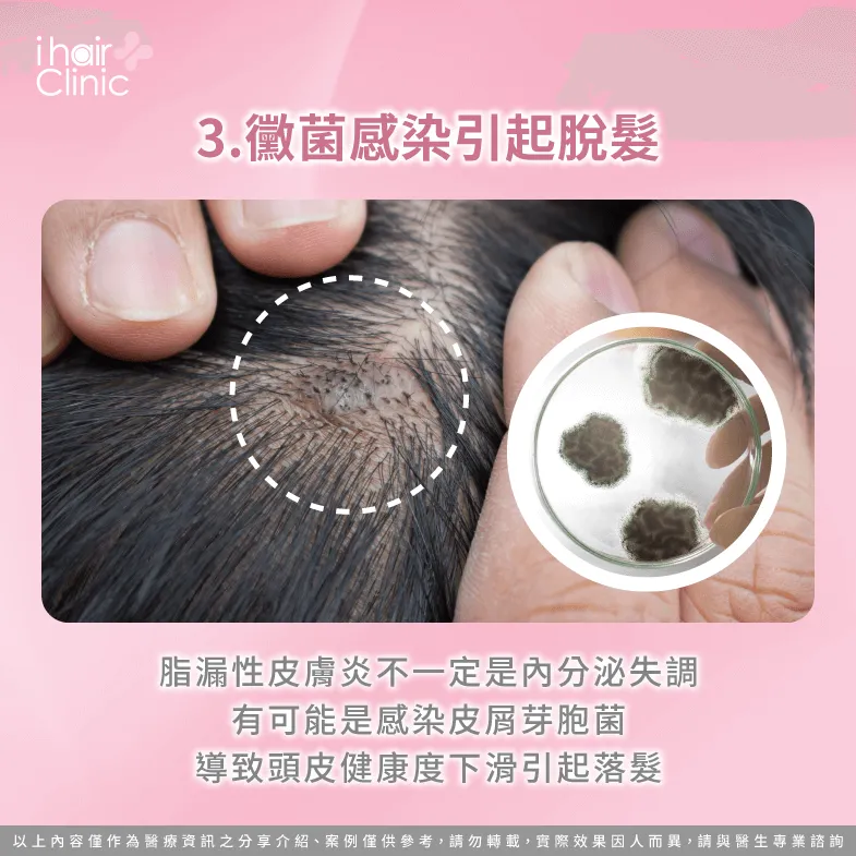 黴菌感染直接影響頭皮健康-脂漏性皮膚炎會掉髮嗎