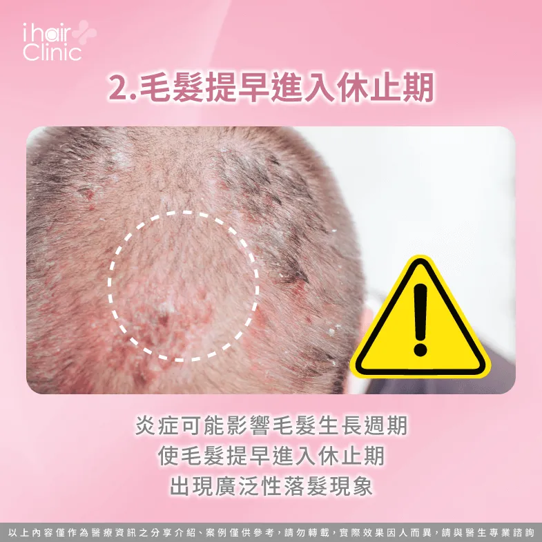 毛囊提早進入休止期並掉髮-脂漏性皮膚炎 掉髮