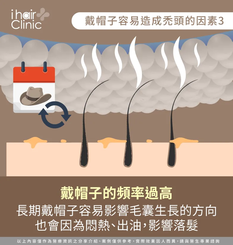 戴帽子的頻率-戴帽子會禿頭嗎