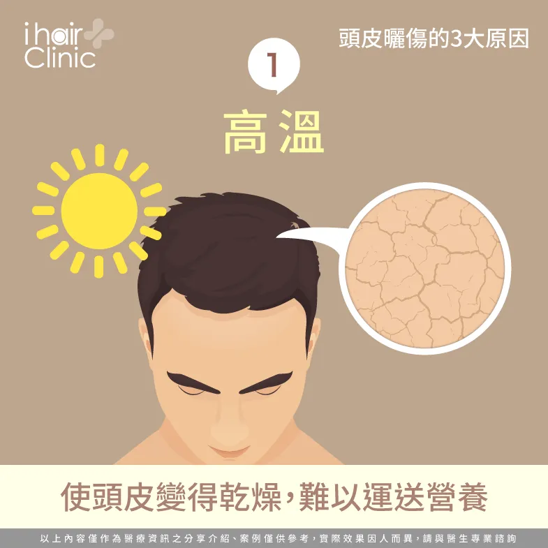 高溫使頭皮乾燥-頭皮曬傷會禿頭嗎