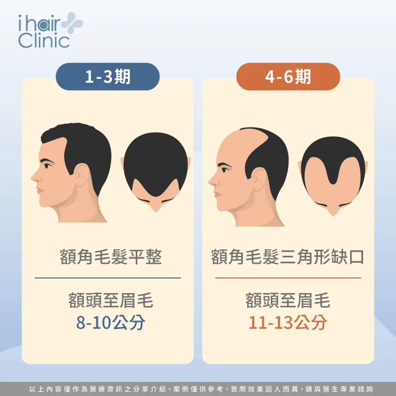 額角、額頭判斷期數-雄性禿期數怎麼看