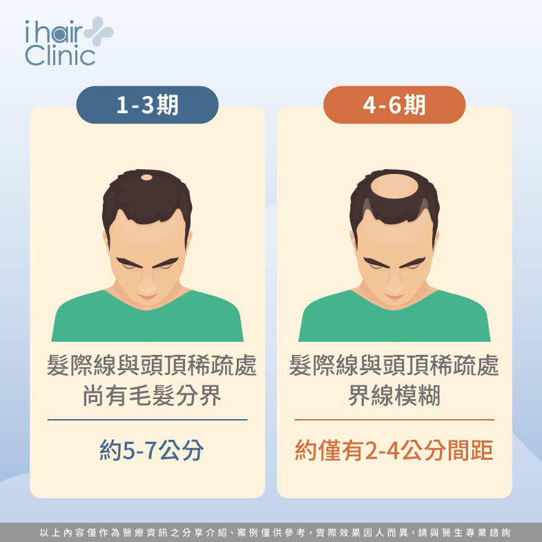 雄性禿期數怎麼看?3個技巧教你正確判斷-ihair風華御髮