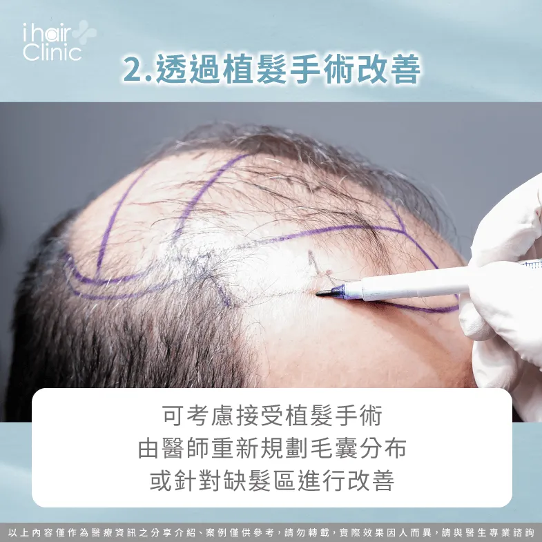 考慮直接接受植髮手術改善缺髮-天生髮量少