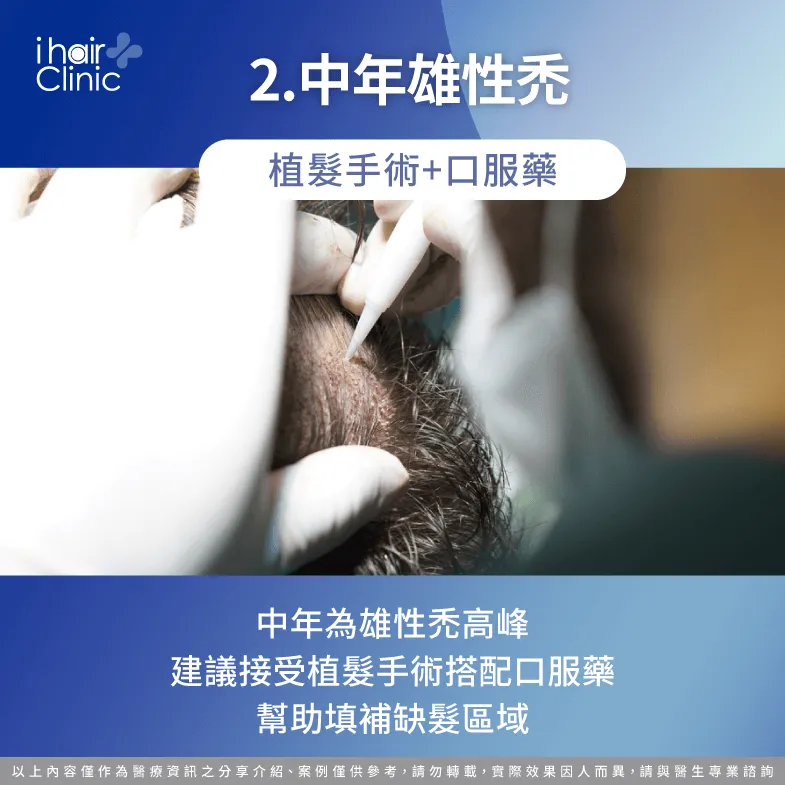 中年雄性禿建議接受植髮手術-雄性禿 年齡