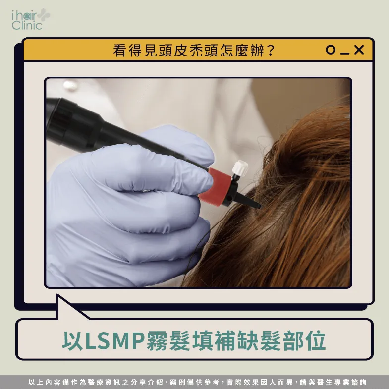 LSMP仿真毛囊霧髮-看得到頭皮算禿頭嗎