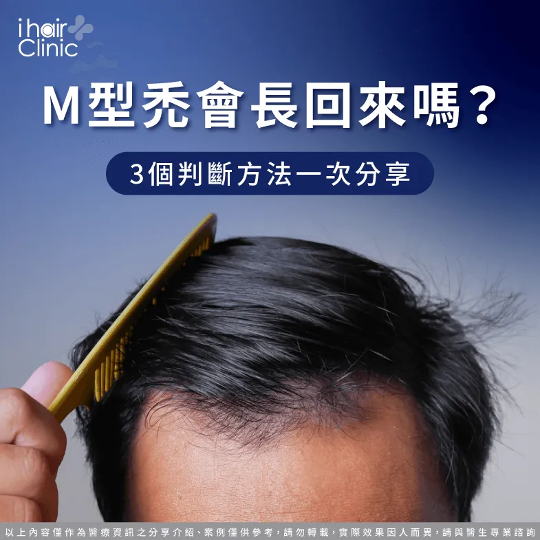 3個重點分析M型禿症狀-M型禿 長回來