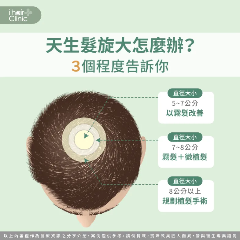 天生髮旋大怎麼改善?先考量3種髮旋大小來規劃 依照3種情形帶你改善髮旋大情形-天生髮旋大怎麼辦