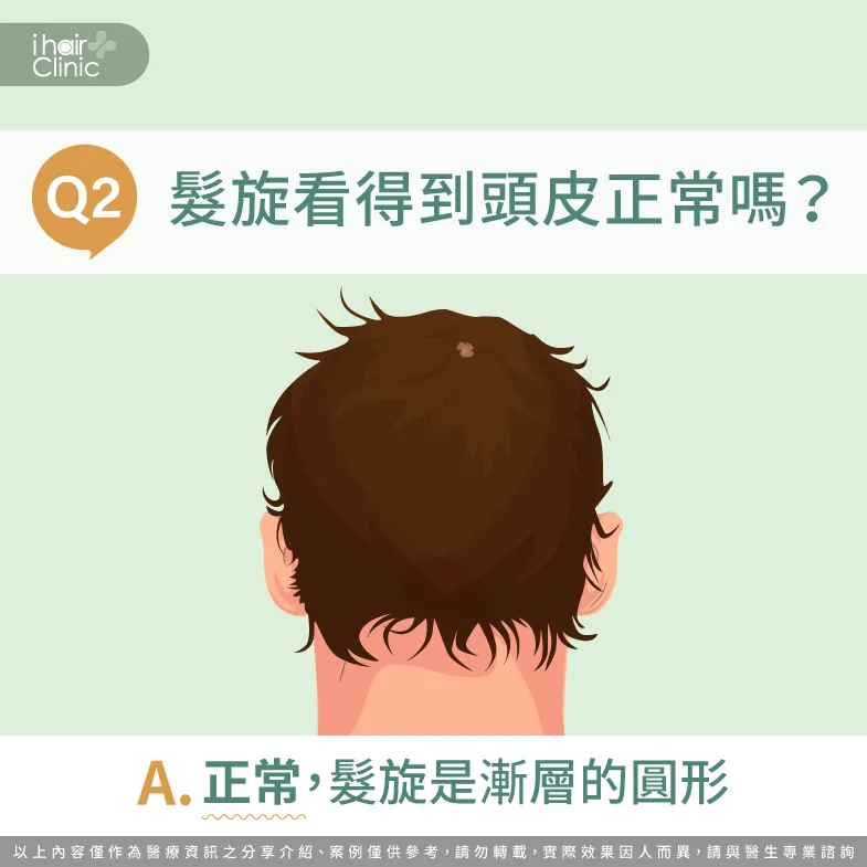 髮旋處看得到頭皮是正常的,因為髮旋是漩渦漸層的圓形! 髮旋處看的到頭皮正常嗎-天生髮旋大怎麼辦