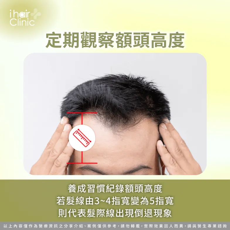 髮友們可以定期觀察額頭高度有無變化,若有發現髮際線明顯後移,應盡早前往植髮診所進行諮詢或治療 定期觀察額頭高度有無變化-髮際線長得回來嗎