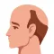 第6期-雄性禿第二期怎麼治療