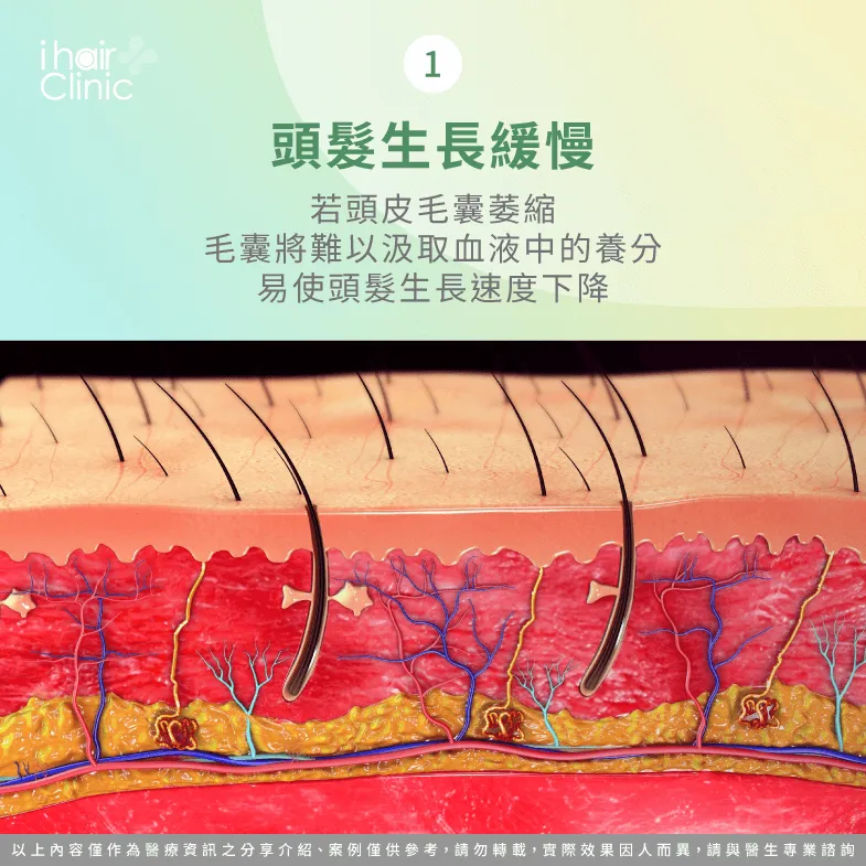 頭髮生長速度明顯下降-如何判斷毛囊萎縮