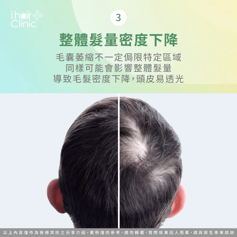 可觀察整體頭髮密度是否下降-如何判斷毛囊萎縮