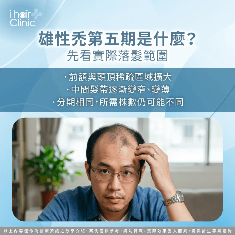 雄性禿第五期是什麼-雄性禿第五期還能植髮嗎