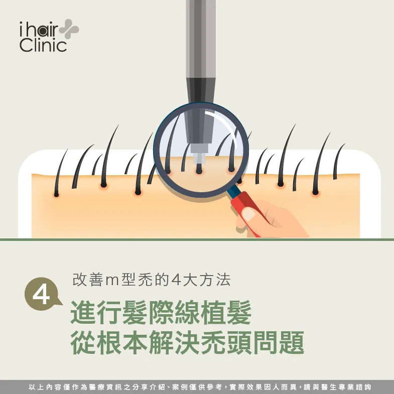 髮際線植髮改善m型禿-m型禿怎麼辦