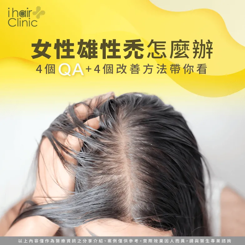 4個相關問答及4個治療方法-女性雄性禿怎麼辦