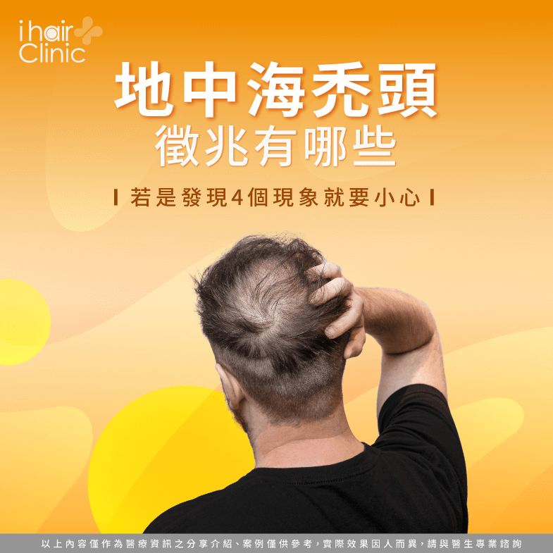 地中海禿頭徵兆有哪些?若是發現4個現象就要小心-ihai…