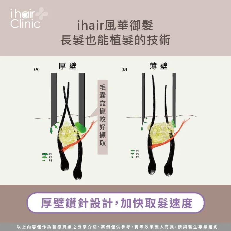 厚壁鑽針擷取更快速-植髮理光頭