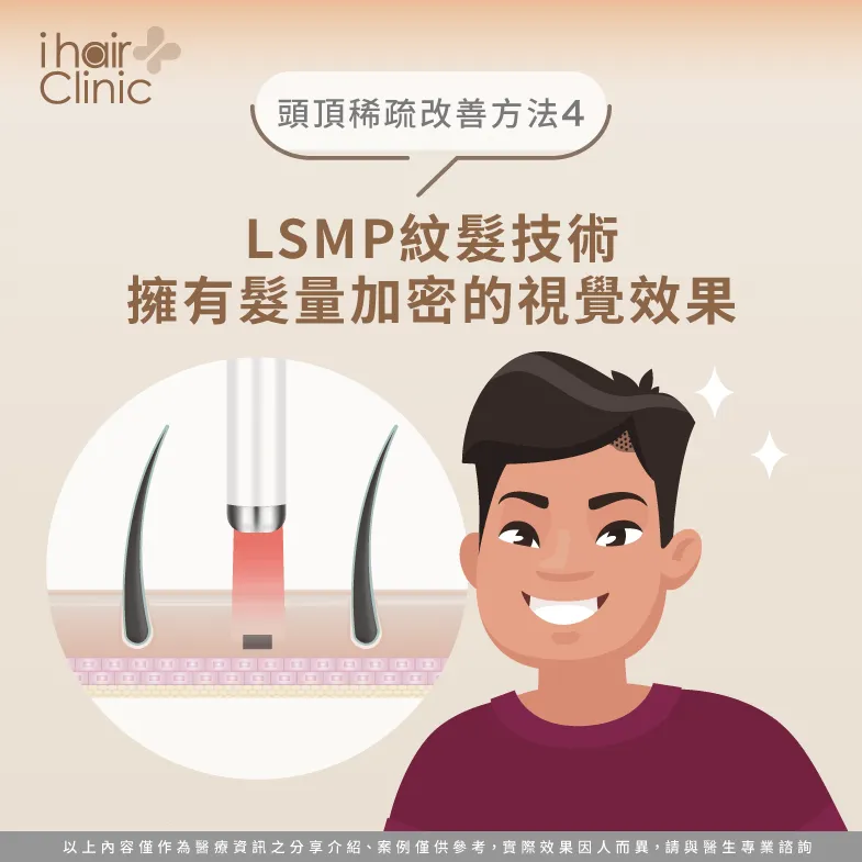 LSMP紋髮技術-頭頂稀疏