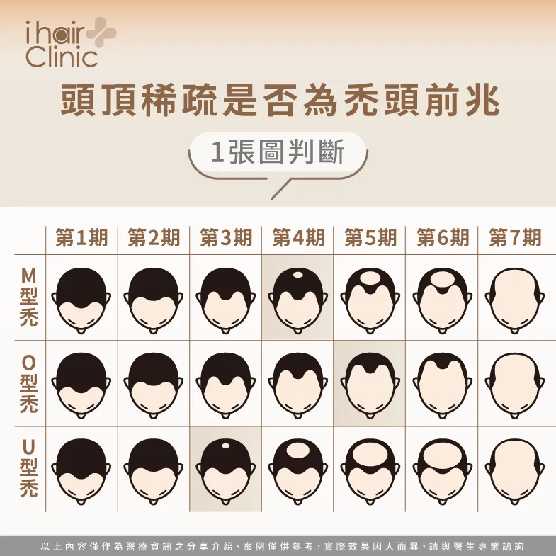 3種男性禿頭類型-頭頂頭髮稀疏男