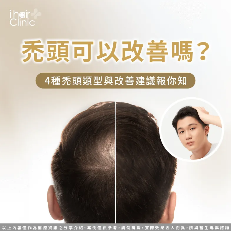 改善禿頭4大建議一次看-禿頭 可以 改善 嗎