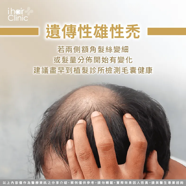 雄性禿初期可透過口服藥與生髮水減緩落髮-禿頭 可以 改善 嗎
