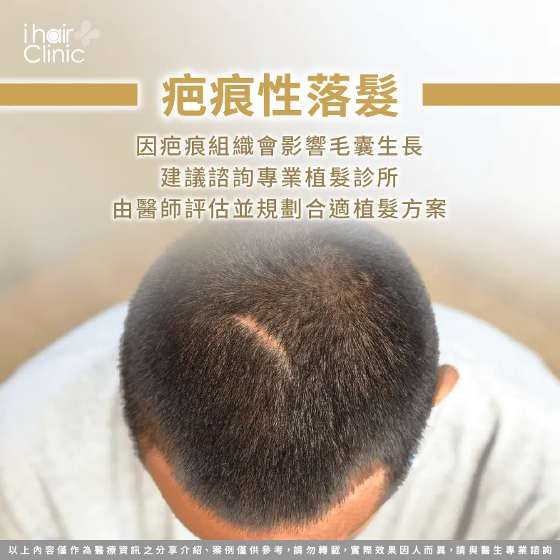 疤痕性落髮建議諮詢植髮診所了解手術方案-禿頭 怎麼 改善