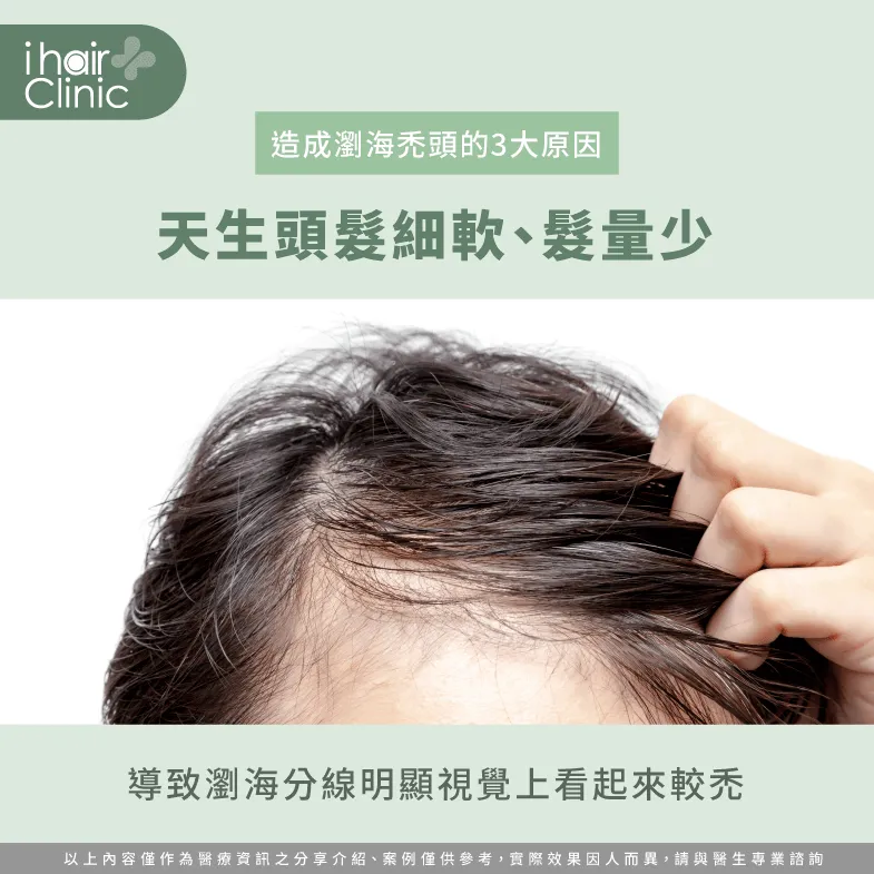 頭髮細軟且髮量少容易導致瀏海分線明顯,視覺上覺得瀏海很禿! 頭髮天生細軟-瀏海禿頭