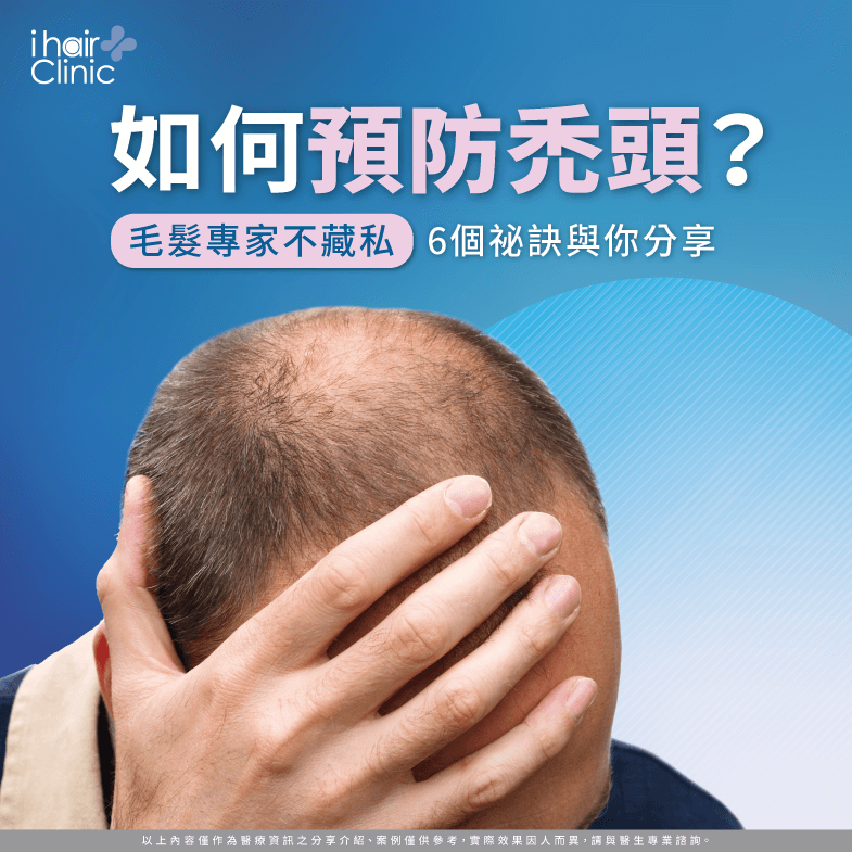禿頭預防的6個注意事項-如何防止禿頭