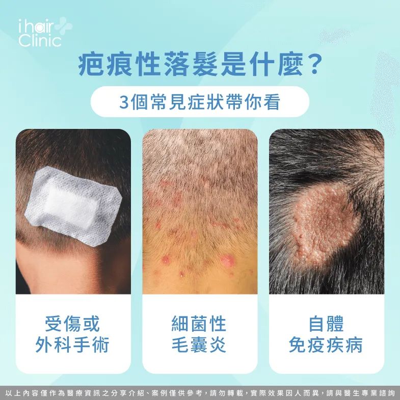 疤痕性禿髮3個常見症狀一次看-疤痕性禿髮