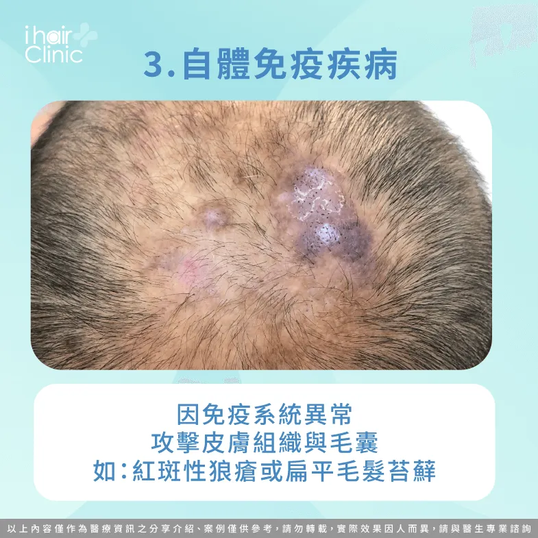 免疫系統異常可能會攻擊皮膚毛囊-疤痕性落髮