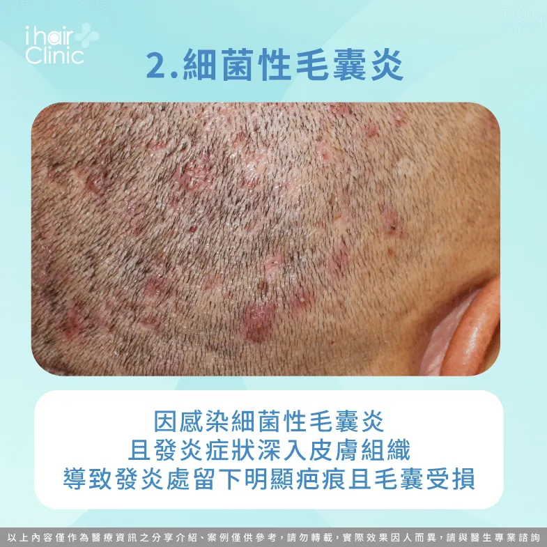 細菌性毛囊炎若延誤治療也可能造成毛囊受損-疤痕性禿髮