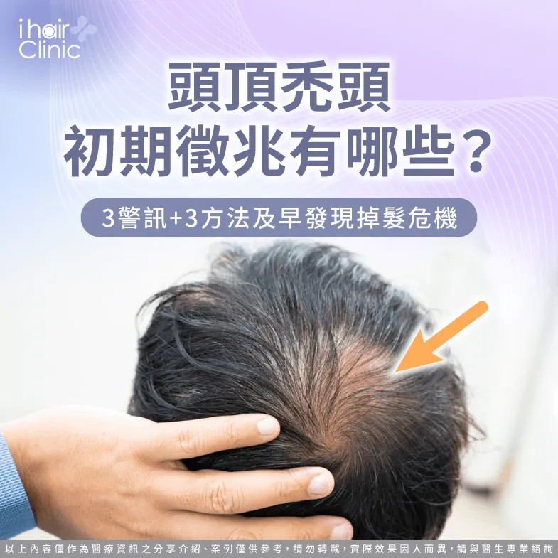 頭頂禿頭初期徵兆-禿頭警訊