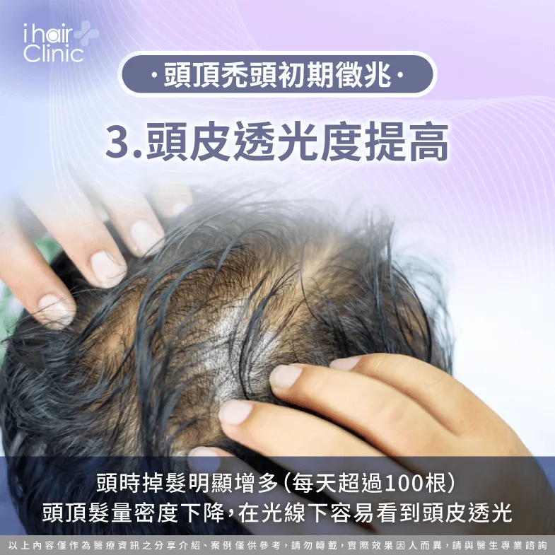 掉髮增加頭皮透光-禿頭初期徵兆