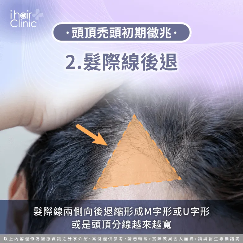 髮際線後退M型禿-禿頭初期徵兆